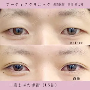 before image