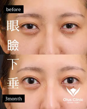 90 days after image