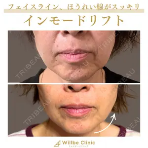 14 days after image