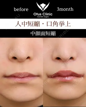 90 days after image