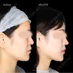 90 days after image