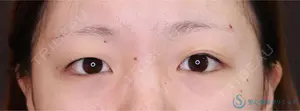 before image