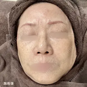 0 days after image