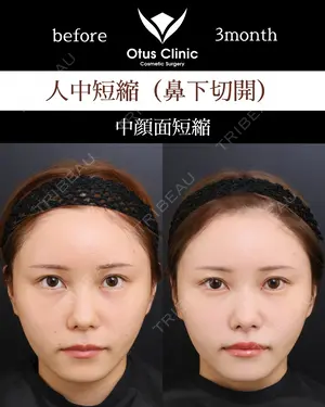 90 days after image