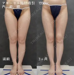 90 days after image