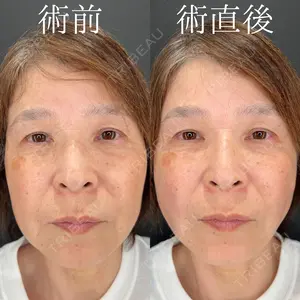 0 days after image