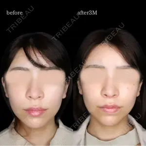 90 days after image
