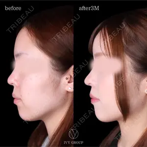 90 days after image
