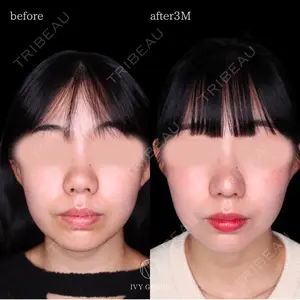 90 days after image