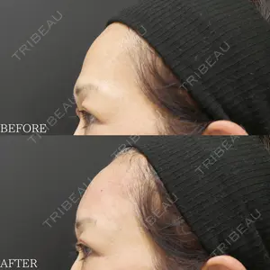 0 days after image