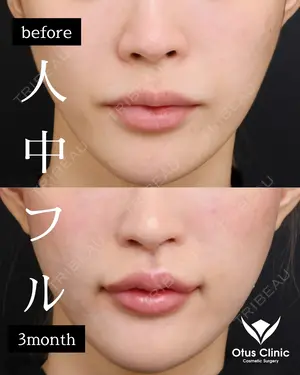 90 days after image