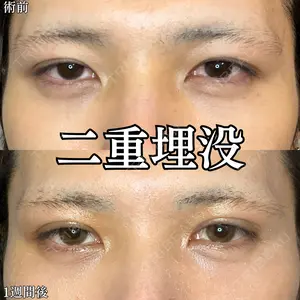 before image