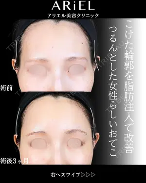 before image