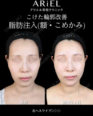 90 days after image