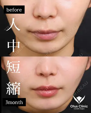 90 days after image