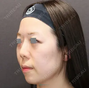 0 days after image