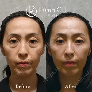 90 days after image