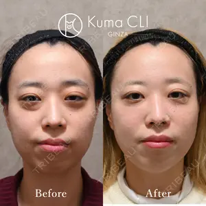 90 days after image