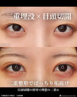 90 days after image