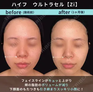 before image