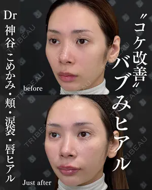 before image