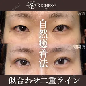 before image