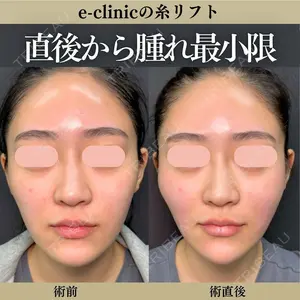 0 days after image