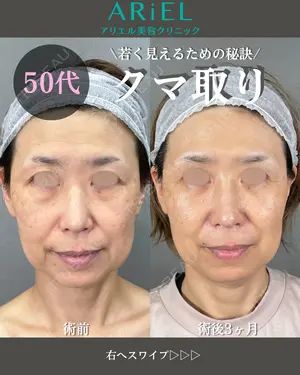 90 days after image