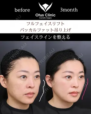 90 days after image
