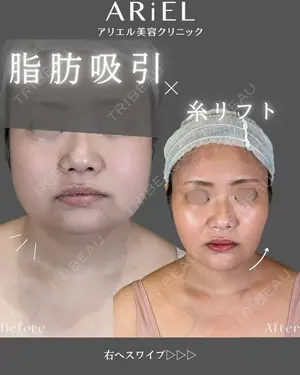 90 days after image