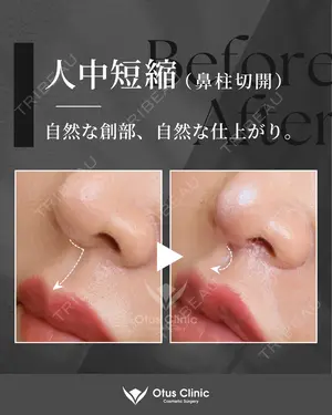 90 days after image