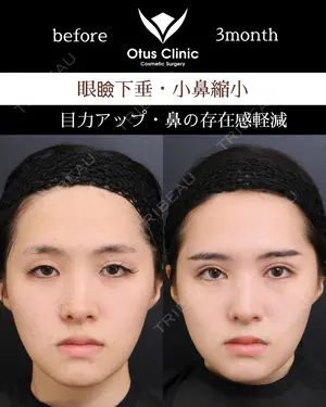 90 days after image
