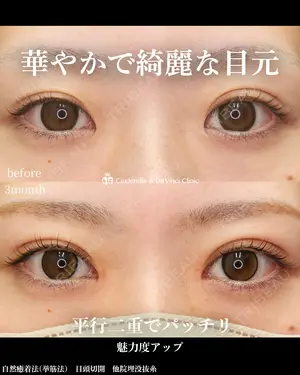 90 days after image