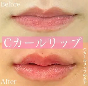 1 days after image