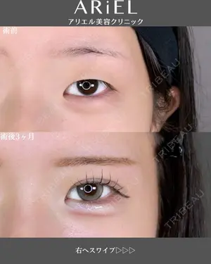 90 days after image