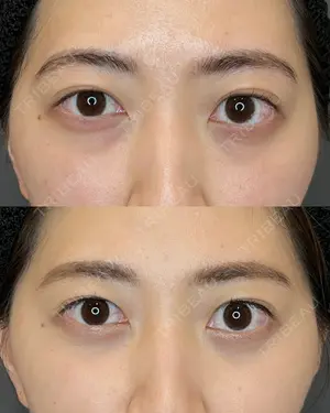 before image
