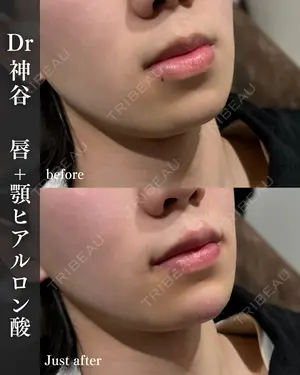 before image