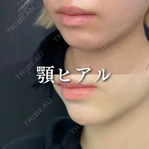 1 days after image