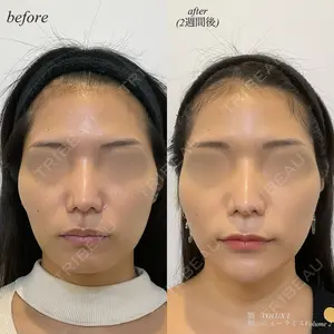 before image