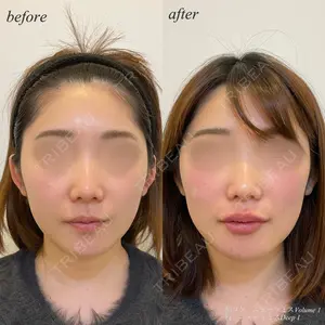 before image