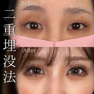 before image
