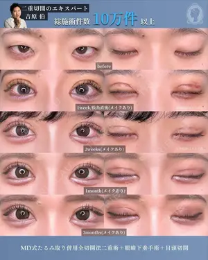 90 days after image