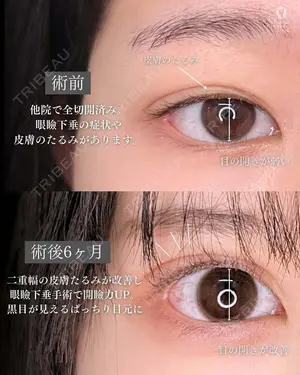 before image