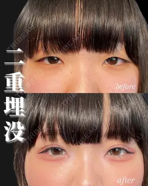 before image