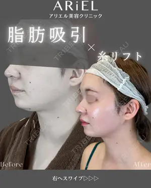 90 days after image
