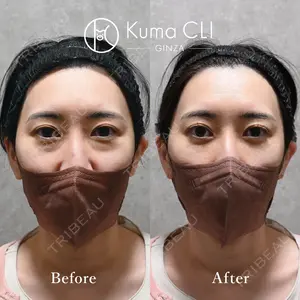 90 days after image