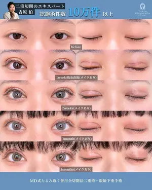 90 days after image