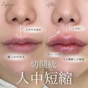 0 days after image