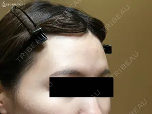 before image