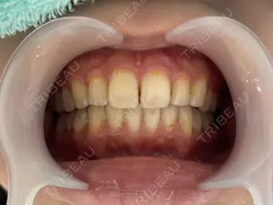 before image